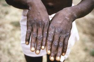 　サル痘から回復途上の患者の手＝１９９７年、コンゴ民主共和国（米疾病対策センター提供・共同）